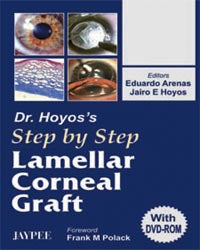 DR.HOYOS' STEP BY STEP LAMELLAR CORNEAL GRAFT WITH DVD-ROM 1/E, 2006, EDUARDO ARENAS