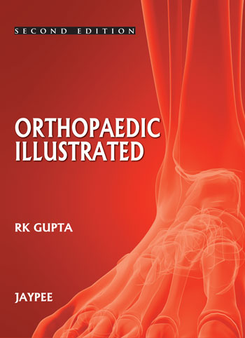 ORTHOPEDICS ILLUSTRATED 2/E, 2013, RK GUPTA