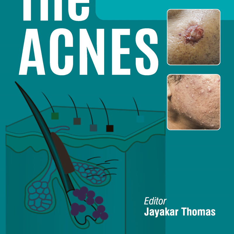 THE ACNES 2/E, 2024, JAYAKAR THOMAS
