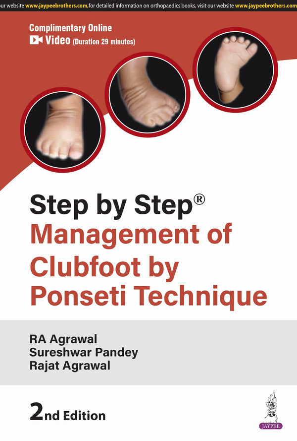 RA AGRAWAL, STEP BY STEP MANAGEMENT OF CLUBFOOT BY PONSETI TECHNIQUE, 2/E, 9789366164441