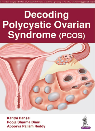 DECODING POLYCYSTIC OVARIAN SYNDROME (PCOS) 1/E, 2017, KANTHI BANSAL