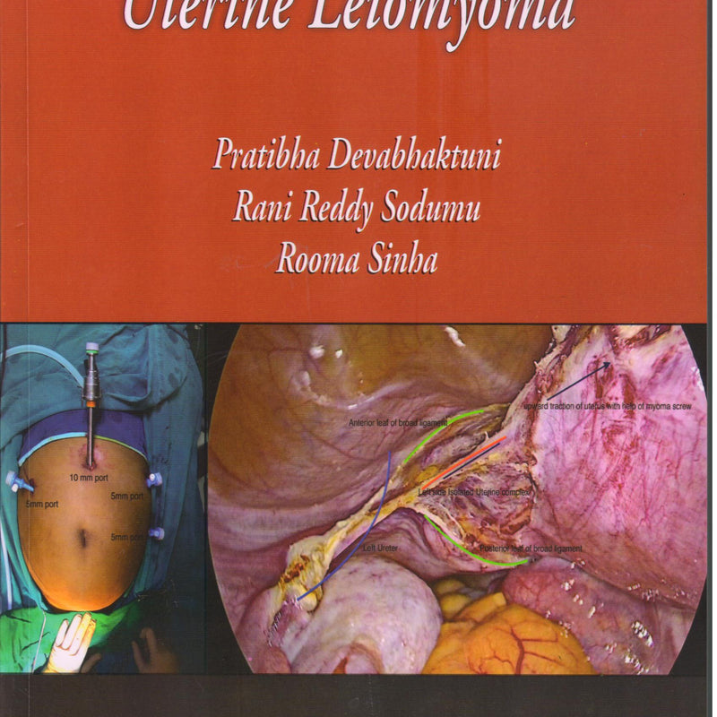 Uterine Leiomyoma (paperback) 1st/e by  Pratibha Devabhaktuni