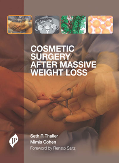 COSMETIC SURGERY AFTER MASSIVE WEIGHT LOSS 1/E, 2013, SETH R THALLER