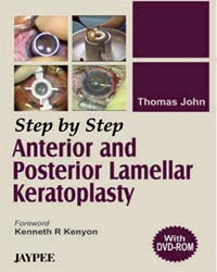 STEP BY STEP ANTERIOR AND POSTERIOR LAMELLAR KERATOPLASTY(WITH DVD) 1/E, 2006, THOMAS JOHN