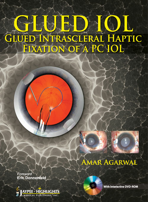 GLUED IOL GLUED INTRASCLERAL HAPTIC FIXATION OF A PC IOL WITH DVD-ROM 1/E, 2013, AMAR AGARWAL