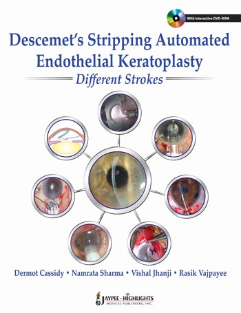 DESCEMET'S STRIPPING AUTOMATED ENDOTHELIAL KERATOPLASTY:DIFFERENT STROKES 1/E, 2013, DERMOT CASSIDY