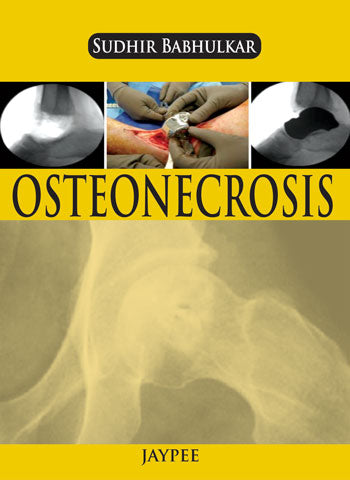 OSTEONECROSIS, 1/E, BY, SUDHIR BABHULKAR