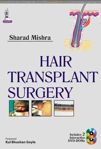 HAIR TRANSPLANT SURGERY, 1/E, BY, SHARAD MISHRA