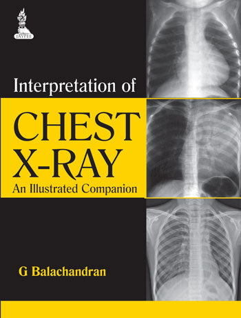 INTERPRETATION OF CHEST X-RAY AN ILLUSTRATED COMPANION, 1/E R.P., BY, G BALACHANDRAN