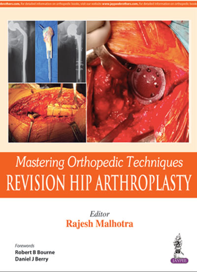 MASTERING ORTHOPEDIC TECHNIQUES REVISION HIP ARTHROPLASTY, 1/E, BY, RAJESH MALHOTRA
