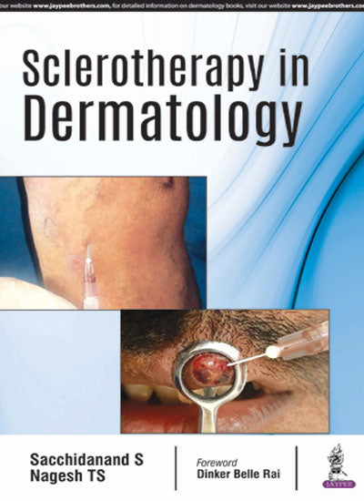 SCLEROTHERAPY IN DERMATOLOGY, 1/E, BY, SACCHIDANAND NAGESH TS