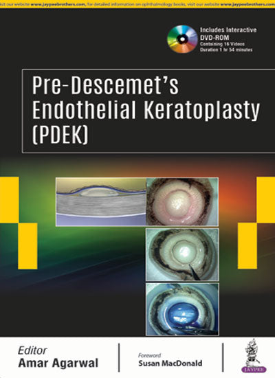 PRE-DESCEMET'S ENDOTHELIAL KERATOPLASTY(PDEK), 1/E, BY, AMAR AGARWAL