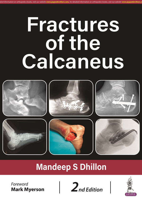 FRACTURES OF THE CALCANEUS 2/E, 2024, MANDEEP S DHILLON
