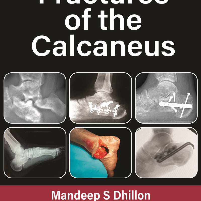 FRACTURES OF THE CALCANEUS, 2/E, BY, MANDEEP S DHILLON