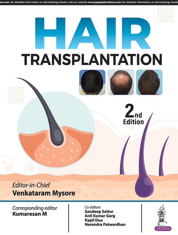HAIR TRANSPLANTATION, 2/E, BY, VENKATARAM MYSORE