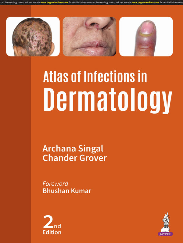 ATLAS OF INFECTIONS IN DERMATOLOGY, 2/E, BY, ARCHANA SINGAL