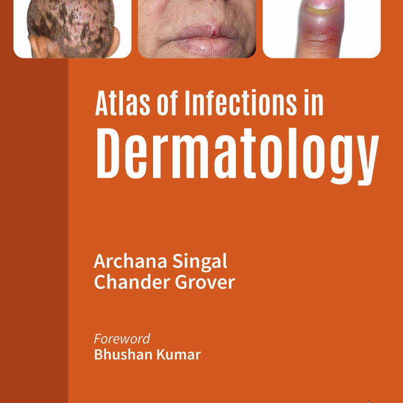 ATLAS OF INFECTIONS IN DERMATOLOGY, 2/E, BY, ARCHANA SINGAL