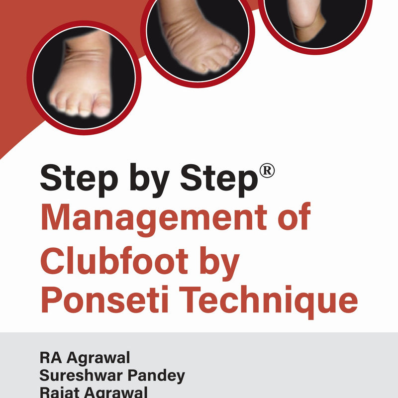 RA AGRAWAL, STEP BY STEP MANAGEMENT OF CLUBFOOT BY PONSETI TECHNIQUE, 2/E, 9789366164441
