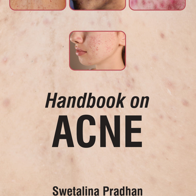 HANDBOOK ON ACNE 1/E, 2025, SWETALINA PRADHAN