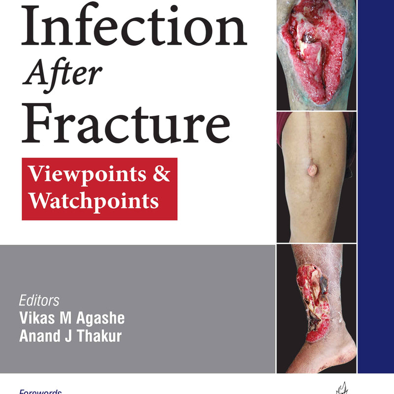 INFECTION AFTER FRACTURE : VIEWPOINTS & WATCHPOINTS, 1/E, BY, VIKAS M AGASHE