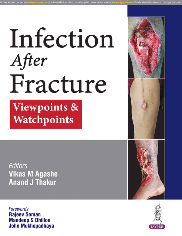 INFECTION AFTER FRACTURE : VIEWPOINTS & WATCHPOINTS, 1/E, BY, VIKAS M AGASHE