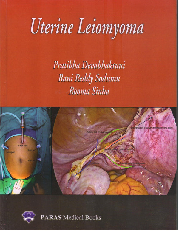 Uterine Leiomyoma (paperback) 1st/e by  Pratibha Devabhaktuni
