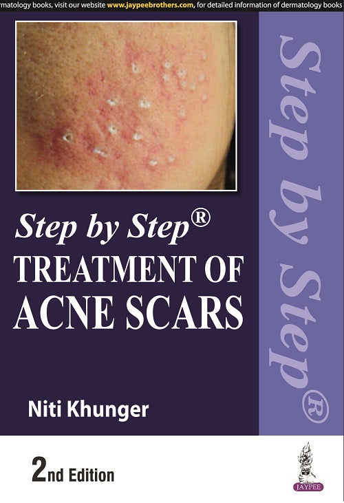 STEP BY STEP TREATMENT OF ACNE SCARS, 2/E, BY, NITI KHUNGER