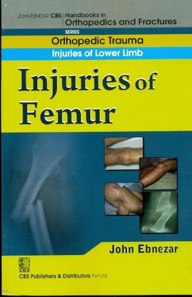 In Juries Of Femur (Handbook In Orthopedics And Fractures Vol 14 Orthopedic Trauma Injuries Of Lower Limb (2012), by John Ebnezar