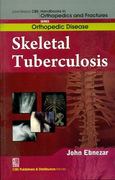 Skeletal Tuberculosis (Handbooks In Orthopedics And Fractures Series Vol 33 Orthopedic Diseases (2012), by John Ebnezar