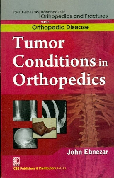 Tumor Conditions In Orthopedics (Handbooks In Orthopedics And Fractures Series Vol 36 Orthopedic Disease (2012), by John Ebnezar