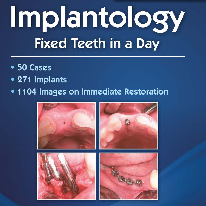 Implantology Fixed Teeth In A Day (Pb 2017) , by F Schrader