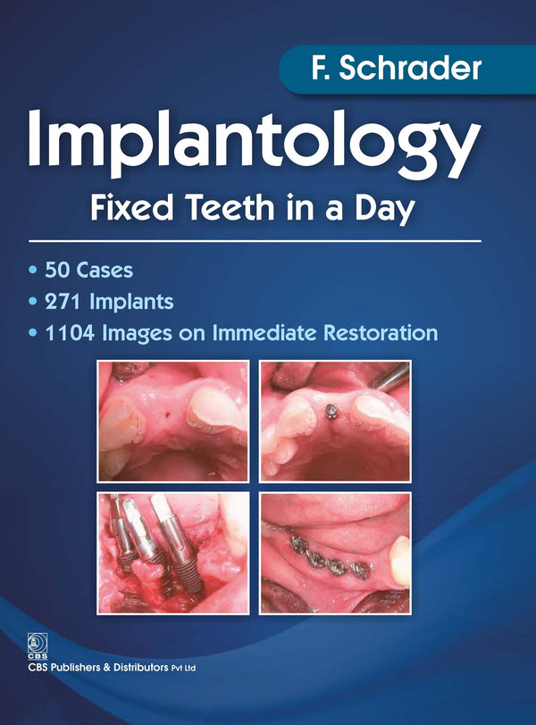 Implantology Fixed Teeth In A Day (Pb 2017) , by F Schrader