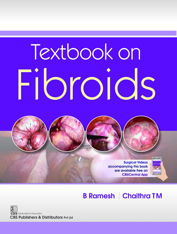Textbook On Fibroids (Pb 2018) , by B Ramesh