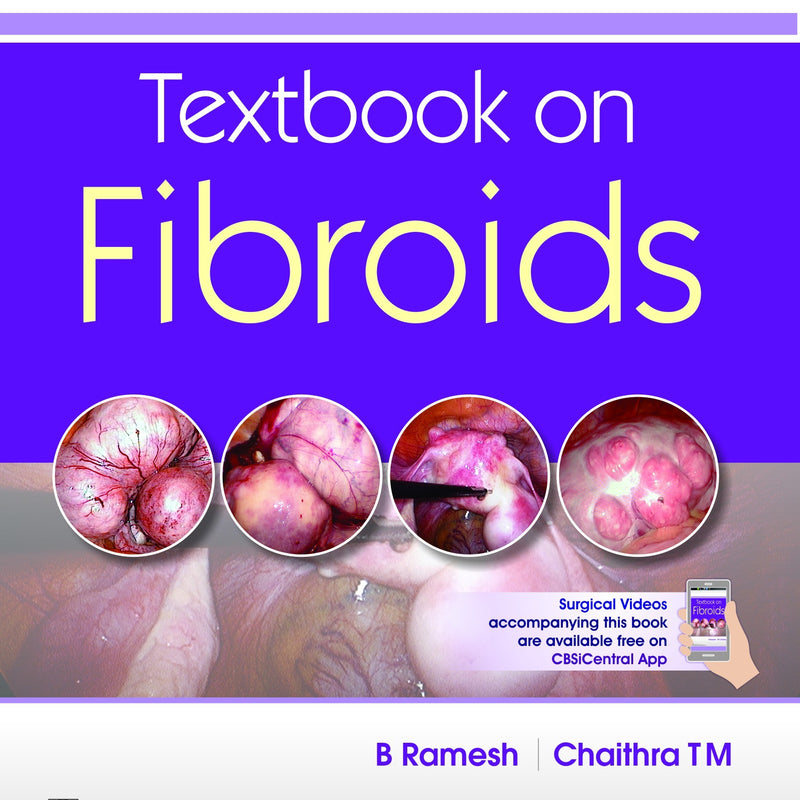 Textbook On Fibroids (Pb 2018) , by B Ramesh