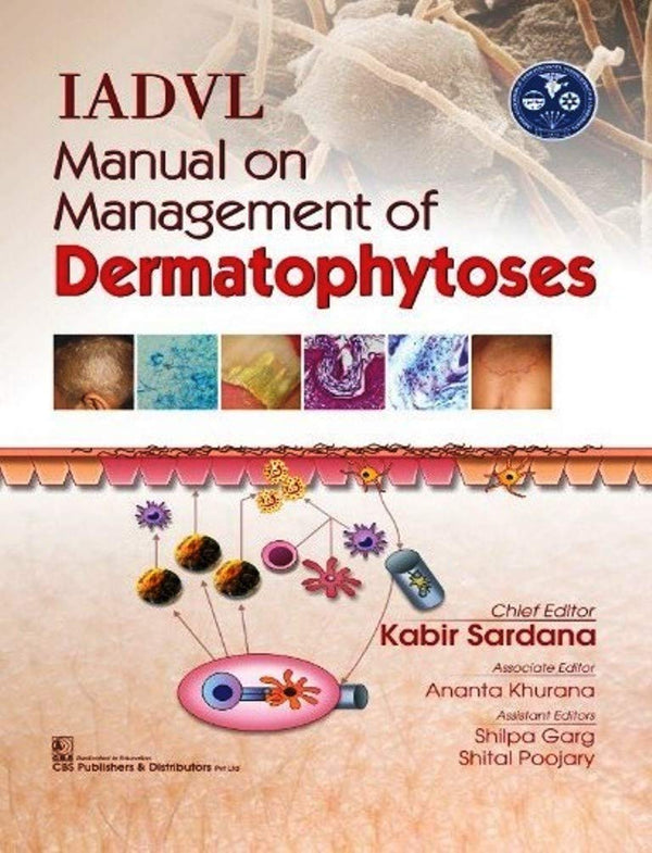 Iadvl Manual On Management Of Dermatophytoses (Hb 2018) , by Kabir Sardana