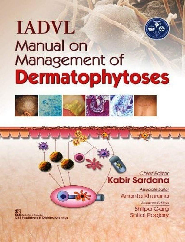 Iadvl Manual On Management Of Dermatophytoses (Hb 2018) , by Kabir Sardana