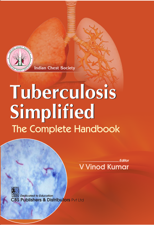 Tuberculosis Simplified The Complete Handbook (HB) by V Vinod Kumar
