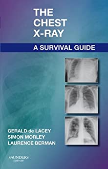 The Chest X-Ray: A Survival Guide, 1e by de Lacey