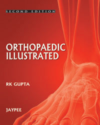 ORTHOPEDICS ILLUSTRATED,2/E,RK GUPTA