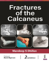 FRACTURES OF THE CALCANEUS 2/E by MANDEEP S DHILLON