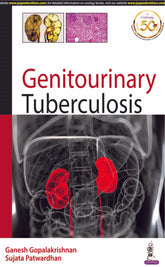 GENITOURINARY TUBERCULOSIS,1/E,GANESH GOPALAKRISHNAN
